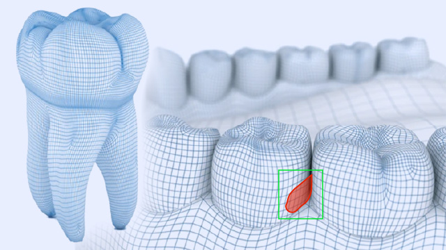 Custom 3D Computer Vision software for dental diagnostics and reconstruction